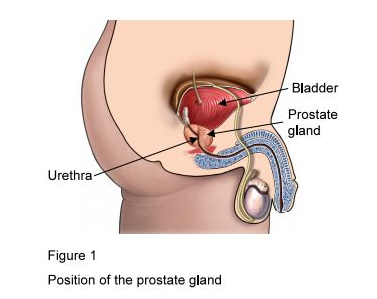 prostate opération