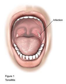 Tonsilectomy voice change - nimfanutrition